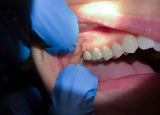 Best Emergency Treatment for Oral Infections in Buford, GA
