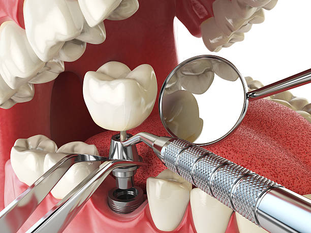 Best Dental Abscess Treatment in Buford, GA